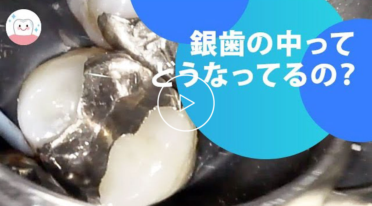 銀歯の中に虫歯を発見！！