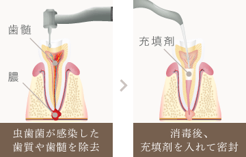虫歯菌が感染した歯質や歯髄を除去。消毒後、充填剤を入れて密封。