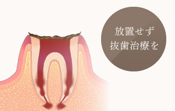 放置せず抜歯治療を