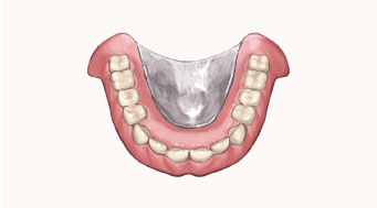 金属床義歯