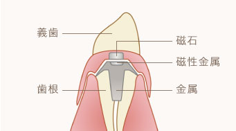 アタッチメント義歯