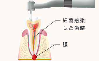 細菌感染した歯髄、膿