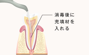 消毒後に充填剤をいれる