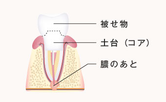 被せ物、土台、膿のあと