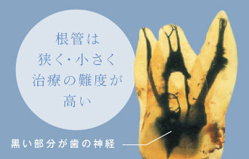 根管は狭く・小さく治療の難度が高い 黒い部分が歯の神経