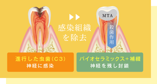 「進行した虫歯（神経に感染）」の感染組織を除去「バイオセラミックス+補綴（神経を残し封鎖）