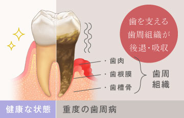歯を支える歯周組織が後退・吸収