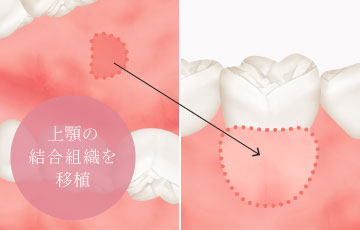 上顎の結合組織を移植