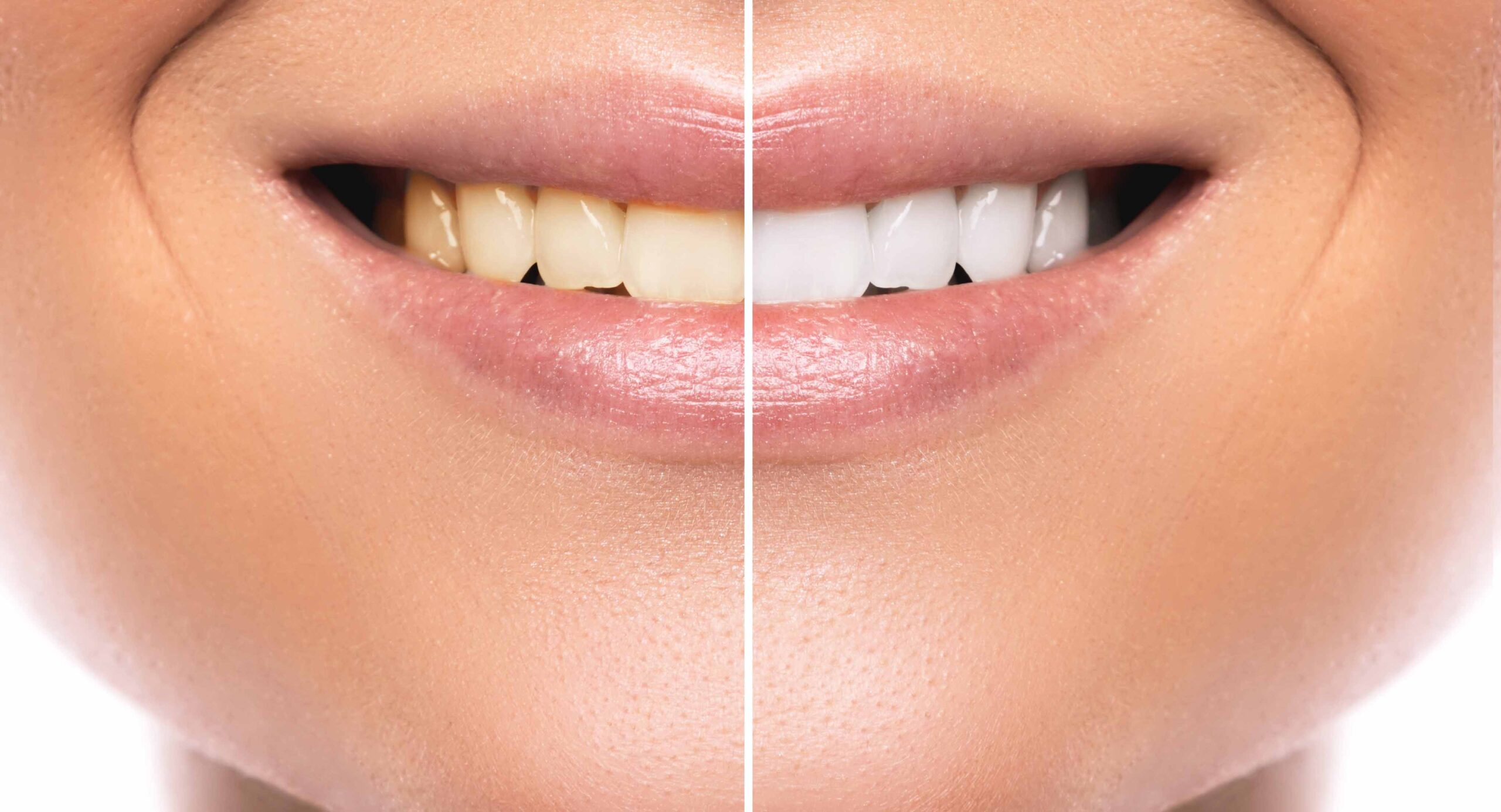 ホワイトニング前とホワイトニング後の歯の比較