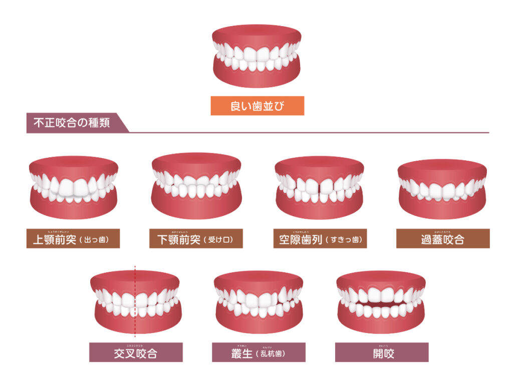 噛み 合わせ 悪い 歯 が 痛い