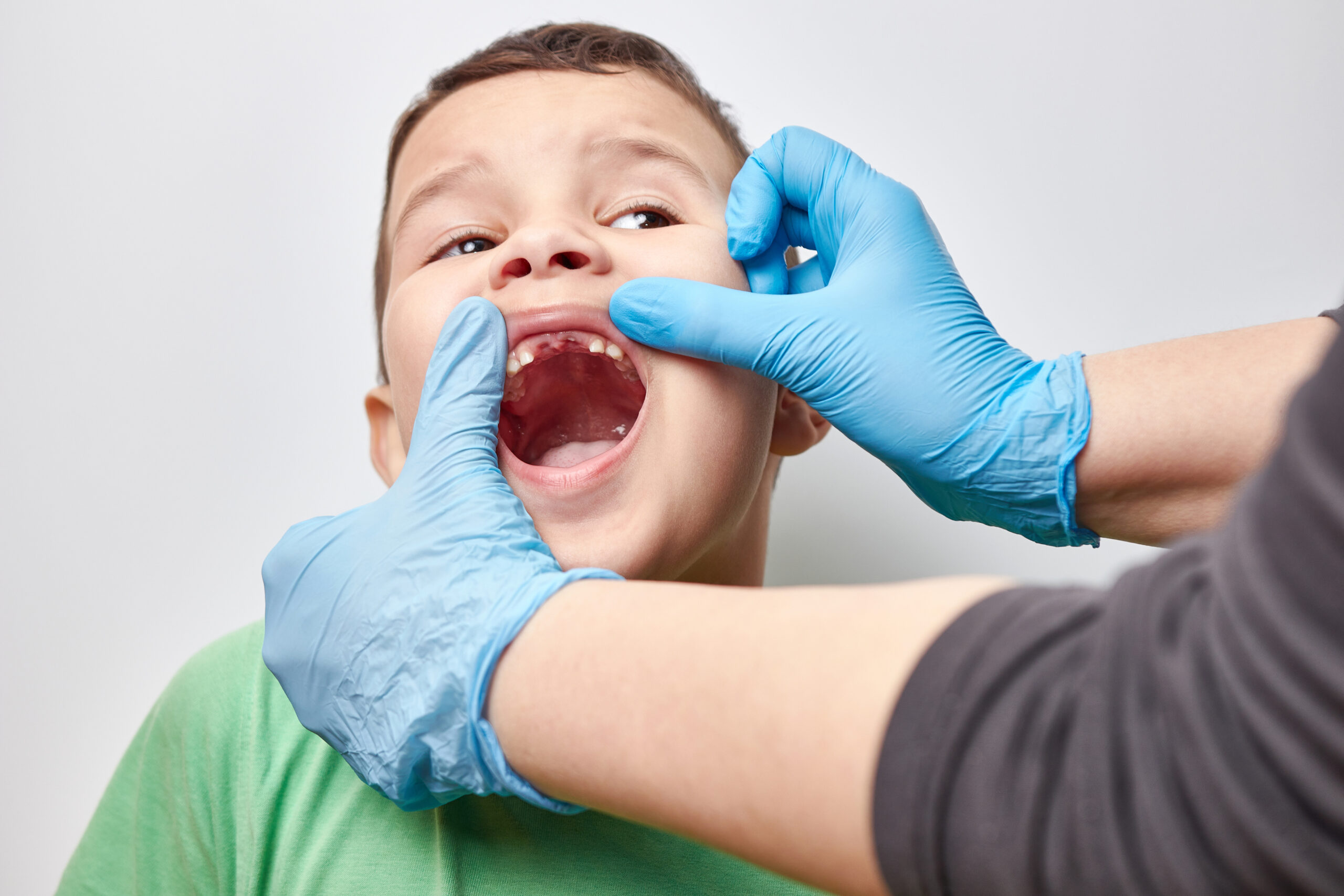 前歯が抜けた男の子の口元を確認する歯科医師