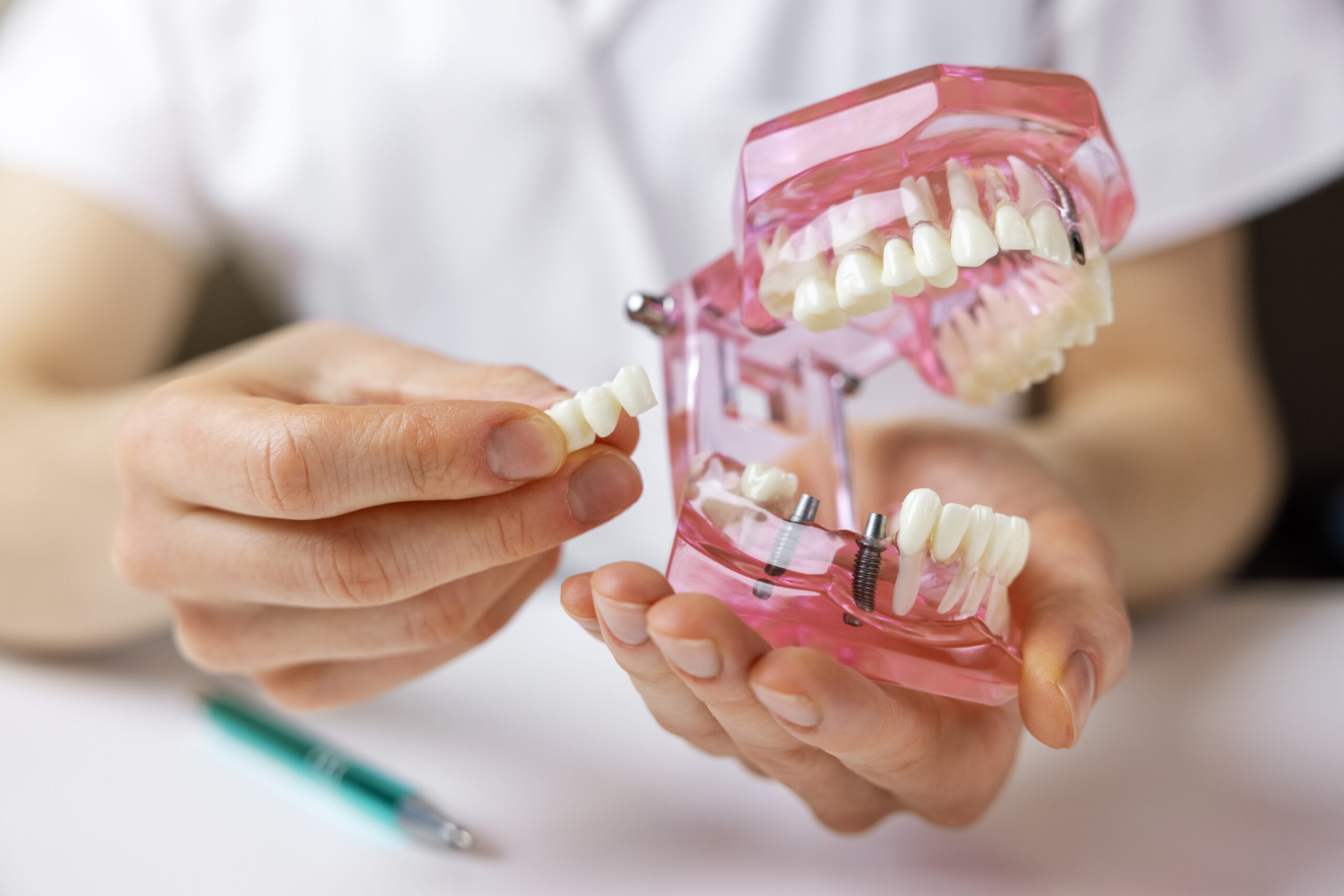 歯の模型を持ってインプラントの説明をする歯科医師