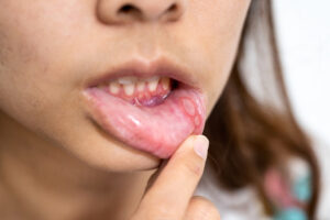 口内炎の症状2