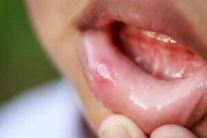 口内炎の症状1