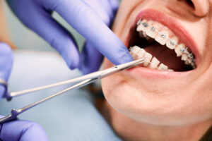 歯科医院で矯正装置をつけてもらう患者