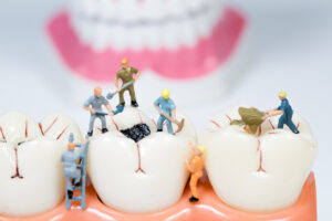 虫歯治療のイメージ