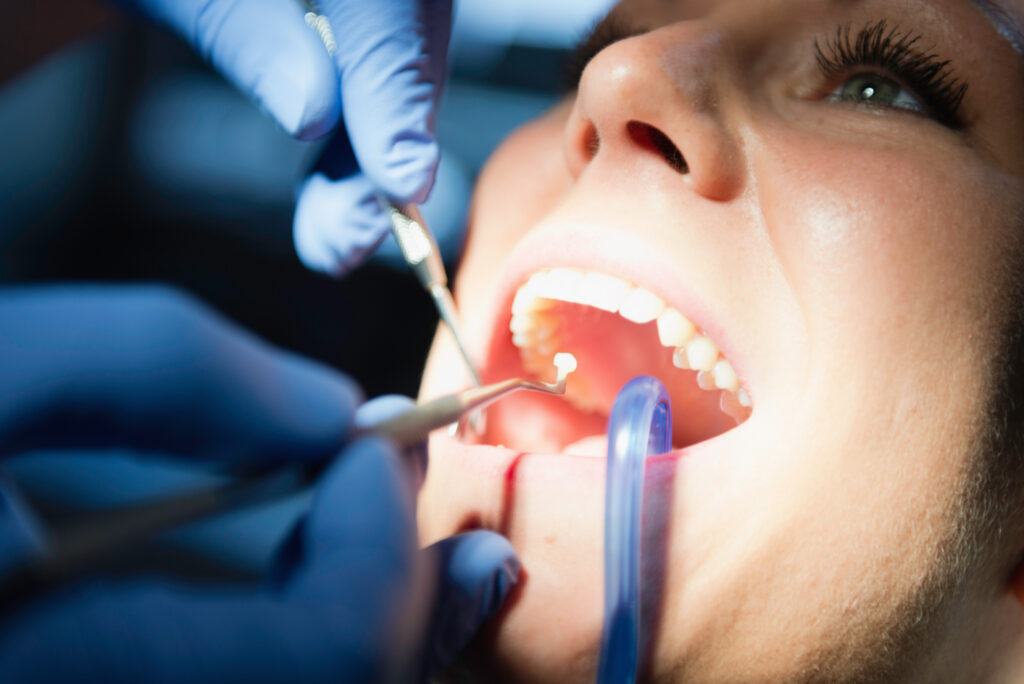 歯科医院で詰め物の治療を受ける女性