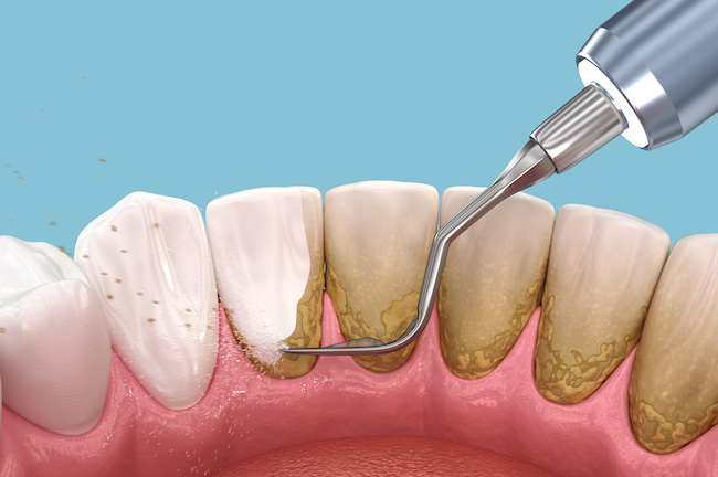 歯周病の原因のプラーク