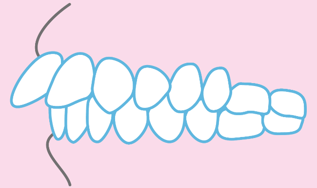 前歯のイメージ図