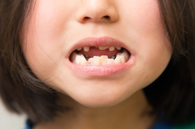 小児矯正が必要な受け口の子ども