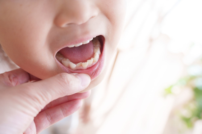 叢生の子どもの下の歯