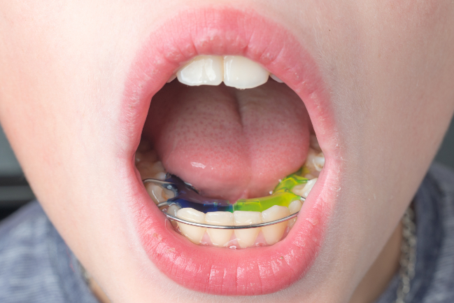 インビザライン・ファーストの治療後にリテーナーを装着する子ども